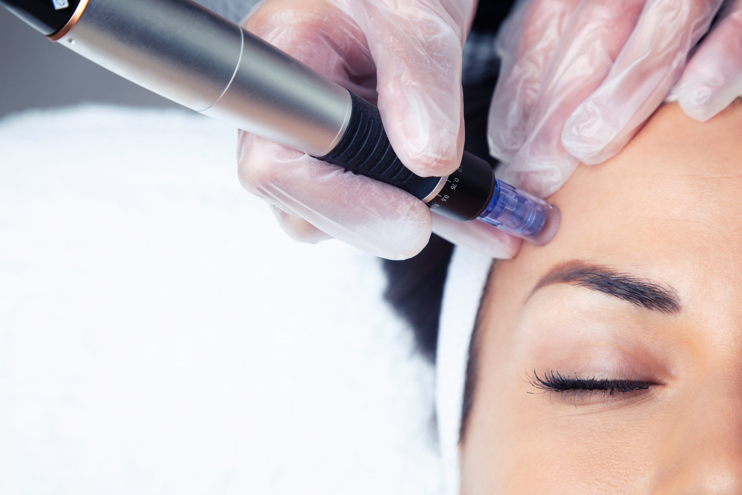 microneedling-results-microneedling-before-and-after