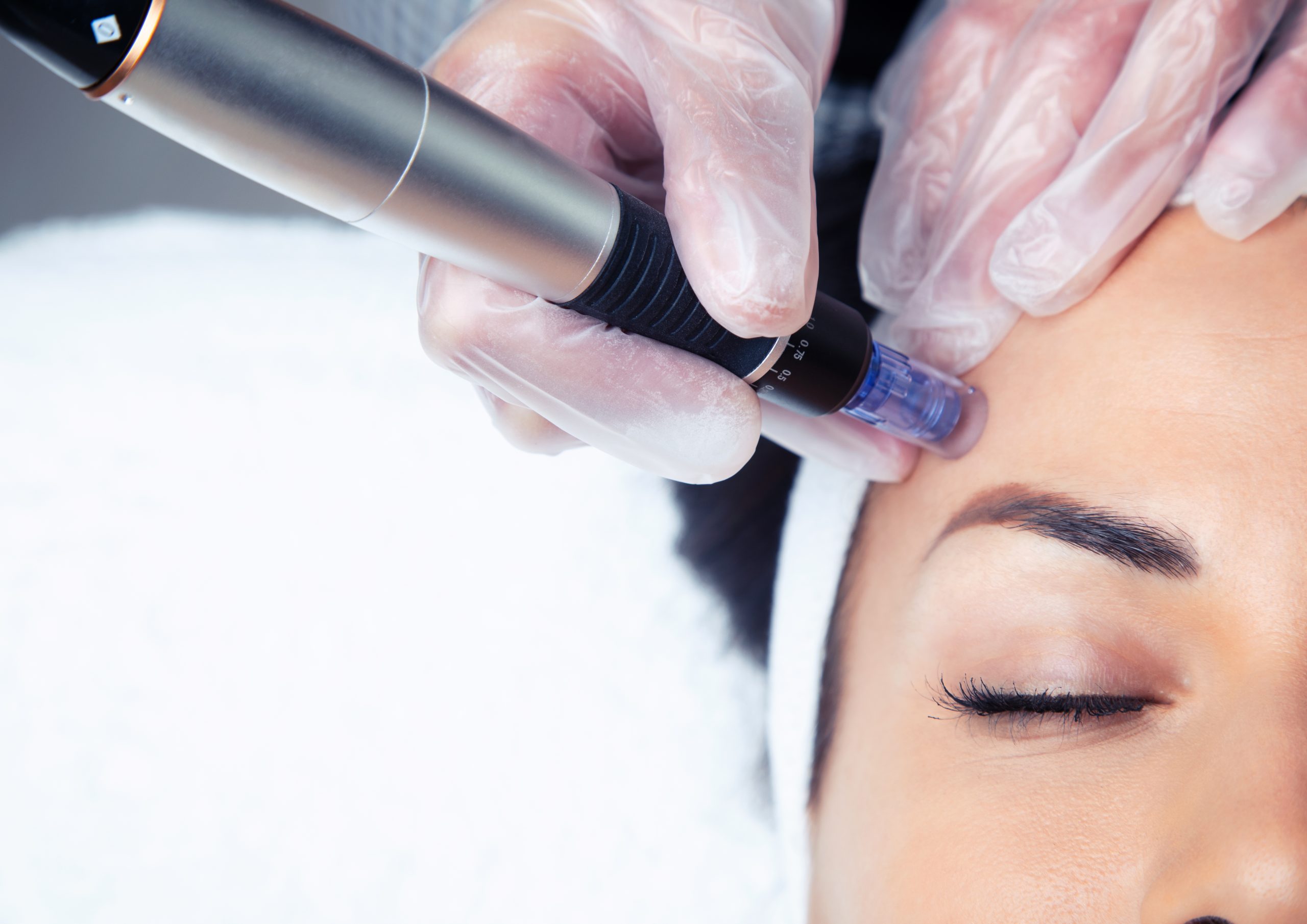 microneedling-results-microneedling-before-and-after